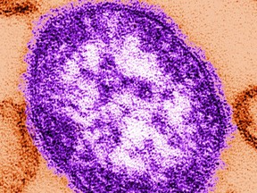 This undated image made available by the Centers for Disease Control and Prevention on Feb. 4, 2015 shows an electron microscope image of a measles virus particle. Measles is considered one of the most infectious diseases known. The virus is spread through the air when someone infected coughs or sneezes.