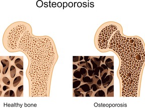 Comparison of normal bone (left) with osteoporosis.