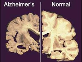 This undated file image provided by , shows a cross section of a normal brain, right, and one of a brain damaged by advanced Alzheimer's disease.