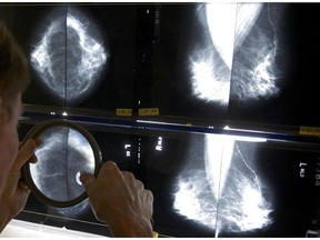 A radiologist uses a magnifying glass to check mammograms for breast cancer in Los Angeles in May 2010.