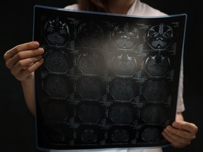 A doctor viewing an mri x-ray of the brain.