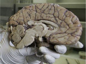 A researcher holds half a human brain: Pushers of certain brain supplements claim that they counter memory loss and enhance mental capacities.