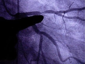 In this Monday, June 24, 2002 file photo, a doctor points to an image of a coronary artery with 80-90 percent blockage in St. Louis.