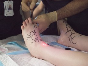 Before operating Wednesday on a 34-year-old woman with lymphedema, surgeons at the CHUM use a special marker to trace over the skin the location of her lymphatic vessels and veins. The surgeons inject a contrast dye between her toes, and with the help of a medical-imaging camera, they're able to see the location of the vessels through the skin.