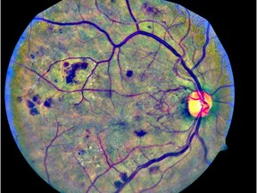 An example of a diabetic patient's eye with changes in the blood vessels of the retina indicating damage that could lead to blindness, unless treated.