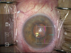 The Opmi Lumera 700 microscope uses optical coherence tomography to peer deep into the eye.