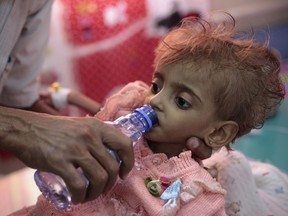 FILE - In this Thursday, Sept. 27, 2018, file photo, a father gives water to his malnourished daughter at a feeding center in a hospital in Hodeida, Yemen. An international aid group says an estimated 85,000 children under age 5 may have died of hunger and disease since the outbreak of Yemen's civil war in 2015.