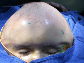 hydrocephalus-surgery-video