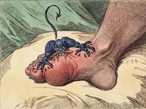 The Gout (1799), by British caricaturist James Gillray, depicts the pain of gout.