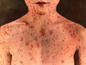 The measles virus can spread to others through coughing and sneezing, according to the U.S. Centres for Disease Control.
