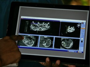 A doctor shows a scan of the mouth of a 7-year-old boy inside a hospital in Chennai, India, August 2, 2019. According to the doctors, the boy had started to complain of jaw pain and swelling and investigation revealed the presence of a large lesion with multiple hard structures within the portion of the right side of his jaw. More than 500 teeth were removed from the mouth of the boy, doctors added. REUTERS/P. Ravikumar