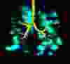 Lung MRI of an ex-smoker of cannabis and tobacco, showing poor lung function and truncated airway tree. In vaping patients, oily substances have also been found inside their lung tissue and airways.