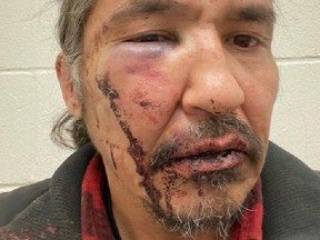 Athabasca Chipewayan Chief Allan Adam is shown in a handout photo provided by Adam after his violent arrest by RCMP.