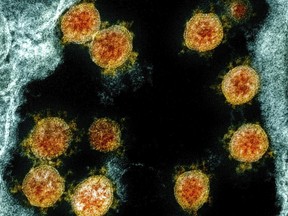 This electron microscope image made available and color-enhanced by the National Institute of Allergy and Infectious Diseases Integrated Research Facility in Fort Detrick, Md., shows Novel Coronavirus SARS-CoV-2 virus particles, orange, isolated from a patient.