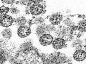 This 2020 electron microscope made available by the U.S. Centers for Disease Control and Prevention image shows the spherical coronavirus particles from the first U.S. case of COVID-19.