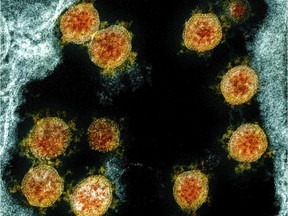 This electron microscope image made available and colour-enhanced by the U.S. National Institute of Allergy and Infectious Diseases Integrated Research Facility in Fort Detrick, Md., shows Novel Coronavirus SARS-CoV-2 virus particles, orange, isolated from a patient. Over the centuries, science has refined its understanding of how illnesses are transmitted.