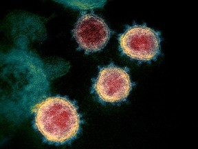 Researchers at the University of British Columbia have discovered what they are calling a "weak spot" in the virus that causes COVID-19. This undated electron microscope image made available by the U.S. National Institutes of Health in February 2020 shows the virus, isolated from a patient in the U.S.