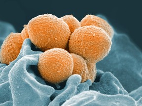 This handout image provided by the National Institute of Allergy and Infectious Diseases shows an electron microscope image of Group A Streptococcus (orange) during phagocytic interaction with a human neutrophil (blue).  The same bacteria that cause simple strep throat sometimes trigger bloodstream or even flesh-eating infections instead, and over the years, dangerous cases have increased.
