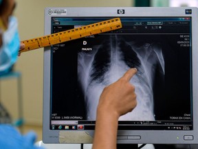 A doctor checks the chest X-ray of a COVID-19 patient in the intensive care unit of Santo Tomas Hospital, in Panama City on May 6, 2020.