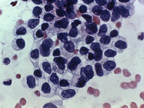This photomicrograph shows cancerous cells detected by a Pap test. "The worst-case scenario may be that we see more symptomatic patients in the years to come, because of delayed screening," writes Dr. Ya Ning Gao.