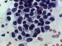 This photomicrograph shows cancerous cells detected by a Pap test. 