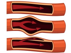 Drawings of three blood vessels, one normal, one with a bulge and one in which blood enters a sac in the wall