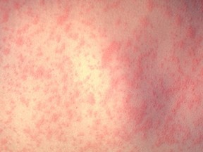 The skin of a patient after three days of measles infection is seen in this handout from the Centers for Disease Control and Prevention.