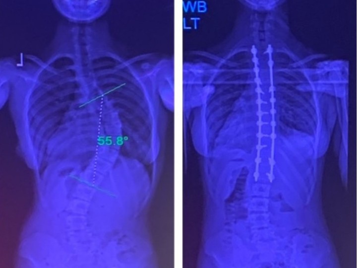  Before and after X-rays of Laval teen Olivia Miranda, who was diagnosed with scoliosis when she was 12. Photo courtesy of Roberto Miranda.