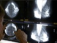 In this May 6, 2010 file photo, a radiologist uses a magnifying glass to check mammograms for breast cancer in Los Angeles.