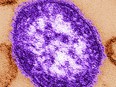 This undated image made available by the Centers for Disease Control and Prevention on Feb. 4, 2015 shows an electron microscope image of a measles virus particle, centre.