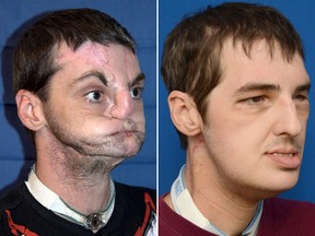 Face Transplant Richard Lee Norris