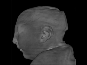 X-ray image showing the damage inflicted on the brain of a girl born with the Zika virus.