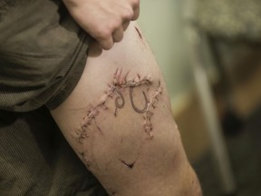 Joseph Tanner, who survived a shark bite while surfing on the Oregon Coast on Oct. 10, 2016, shows his scars while speaking with the media at Legacy Emanuel Medical Center in Portland, Ore., where he is a critical care nurse, Wednesday, Oct. 26, 2016.