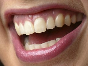 An Alzheimer's drug may help teeth regrow and repair cavities.