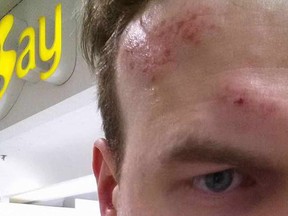 Sean McQuillan displays the damage to his head he says occurred after being wrongfully shoved to the pavement by security after leaving the Hudson's Bay store at Lougheed Town Centre