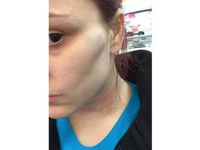 An injury on her neck is visible in a photo posted by a woman who says she narrowly escaped a roadside attack near Sudbury by an unidentified man last week.