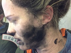 This handout photo taken on February 19, 2017 and released by the Australia Transport Safety Bureau shows a woman after she suffered burns to her face and hands after her headphones caught fire during a flight