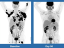 hese scans show a 62-year-old man with non-Hodgkin lymphoma, at left in December 2015, and three months after treatment with Kite Pharma's experimental gene therapy at MD Anderson Cancer Center in Houston