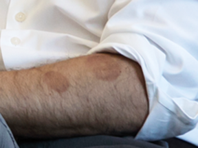 The telltale signs of cupping on Justin Trudeau's arm.