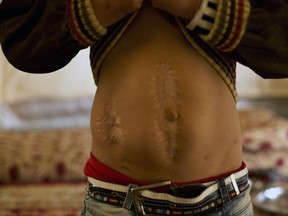 Akram Rasho Khalaf, 10, shows scars from wounds sustained when he had been captured by Islamic State militants