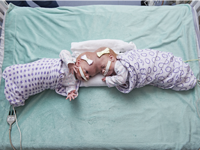 Conjoined twin girls Abby Delaney, right, and Erin at the Children's Hospital of Philadelphia.