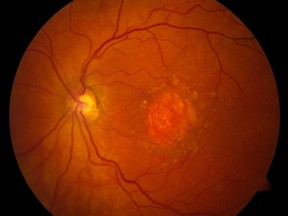 This image provided by the National Eye Institute shows a microscopic image of a retina being damaged by the so-called "dry" form of age-related macular degeneration. An experimental drug is showing promise against an eye disease that blinds older adults. Age-related macular degeneration gradually erodes seniors' central vision, making it difficult to read or see faces. (National Eye Institute via AP)