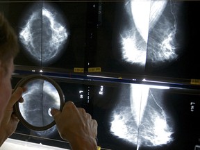 In a file photo, a radiologist examines a mammogram. the Canadian Cancer Society says in a new report one in two Canadians will be diagnosed with Cancer in their lifetimes.