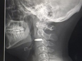 A photo taken by journalist Adam Harvey of his own X-ray clearly shows a bullet