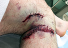 Randal Warnock received 30 stitches after his tangle with a grizzly bear, some on his ring finger and his left knee, but most of them were around his right knee.