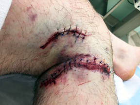 Randal Warnock received 30 stitches after his tangle with a grizzly bear, some on his ring finger and his left knee, but most of them were around his right knee.