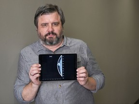 In this July 13, 2017 photo, Associated Press reporter Andrew Dalton holds an iPad displaying an image of his mammogram in downtown Los Angeles. Dalton described his experience as the rare man who underwent a mammogram in a story for the AP.  (AP Photo/Richard Vogel)