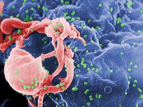 This undated photo provided by the Centers for Disease Control and Prevention shows a scanning electron micrograph of multiple round bumps of the HIV-1 virus on a cell surface. In a report released on Monday, July 24, 2017, researchers said a South African girl born with the AIDS virus has kept her infection suppressed for 8 1/2 years after stopping anti-HIV medicines _ more evidence that early treatment can occasionally cause a long remission that, if it lasts, would be a form of cure. (Cynthia Goldsmith/Centers for Disease Control and Prevention via AP)