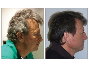 This undated combination of photos provided by the Journal of the American Medical Association in July 2017 shows a cancer patient with gray hair that unexpectedly turned dark while taking new immunotherapy drugs.