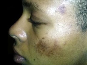 Injuries to Tatyana Hargrove after her June 18, 2017 encounter with police in Bakersfield, Calif.